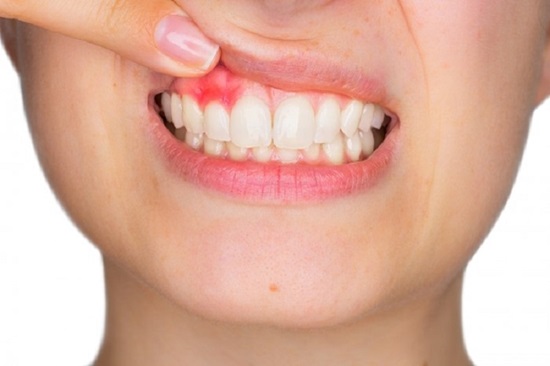 hậu quả khi tẩy trắng răng sai cách