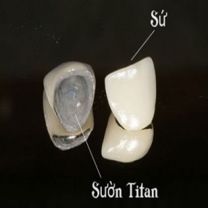 răng sứ titan đạt chuẩn