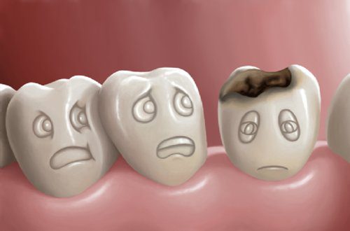 Hình ảnh tượng trưng cho bệnh sâu răng