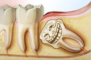 Răng khôn mọc lệch gây đau nhức ảnh hưởng đến sức khỏe răng miệng và toàn thân