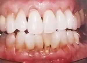 Ê buốt sau khi tẩy trắng răng