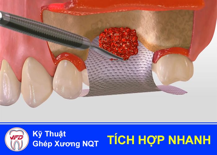 implant-tuc-thi-2