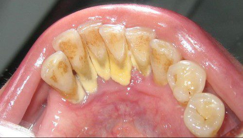 Nên làm gì khi bị sâu răng?