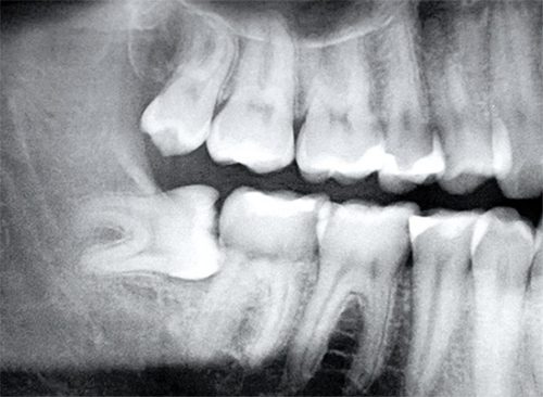 Nhổ răng khôn có nguy hiểm không ?