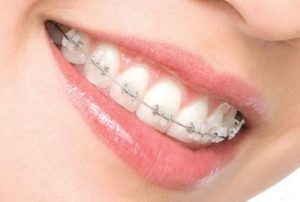 Khi răng hô nhẹ nên niềng răng hay bọc sứ?